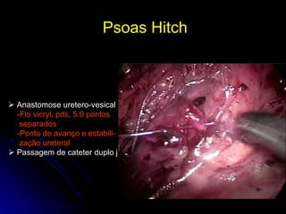 Psoas Hitch     Anastomose uretero-vesical -Fio vicryl, pds, 5.0 pontos  separados -Ponto de avanço e estabili- zação ureteral    Passagem de cateter duplo j 