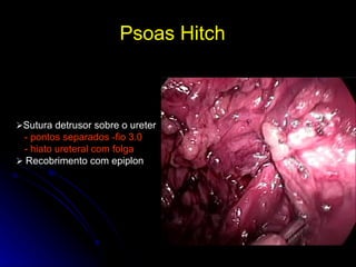 Psoas Hitch   Sutura detrusor sobre o ureter - pontos separados -fio 3.0 - hiato ureteral com folga     Recobrimento com epiplon 