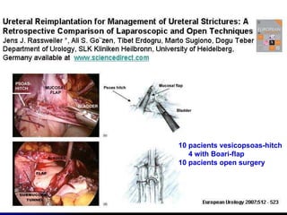 10 pacients vesicopsoas-hitch 4 with Boari-flap 10 pacients open surgery 