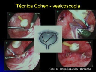 Técnica Cohen - vesicoscopia Holger Til –congresso Europeu - Roma 2008 