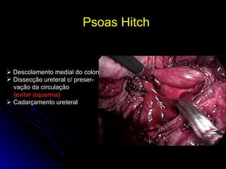 Psoas Hitch      Descolamento medial do colon Dissecção ureteral c/ preser- vação da circulação  (evitar isquemia)    Cadarçamento ureteral 