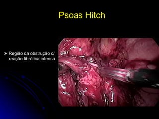 Psoas Hitch     Região da obstrução c/ reação fibrótica intensa 