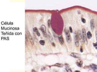 Célula
Mucinosa
Teñida con
PAS
 