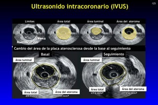 Ultrasonido intracoronario (IVUS) 125 Cambio del área de la placa aterosclerosa desde la base al seguimiento Vena Ramifica...