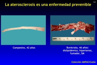 La aterosclerosis es una enfermedad prevenible Campesino, 42 años Burócrata, 46 años: dislipidémico, hipertenso, fumador, ...