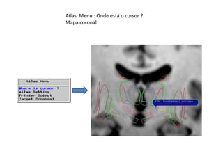 Atlas Menu : Onde está o cursor ?
Mapa coronal
 