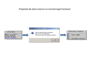 Propostas de alvos comuns na neurocirurgia funcional
 