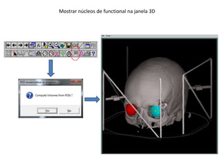 Mostrar núcleos de functional na janela 3D
 