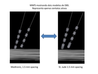 MNPS mostrando dois modelos de DBS.
Representa apenas contatos ativos
Medtronic, 1.5 mm spacing St. Jude 1.5 mm spacing
 