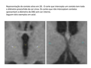 Representação do contato ativo em 2D. O corte que intercepta um contato tem todo
o diâmetro preenchido da cor cinza. Os cortes que não interceptam contatos
apresentam o diâmetro do DBS sem cor interno.
Seguem dois exemplos em axial.
 