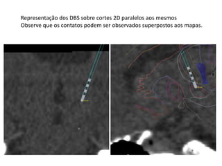 Representação dos DBS sobre cortes 2D paralelos aos mesmos
Observe que os contatos podem ser observados superpostos aos mapas.
 