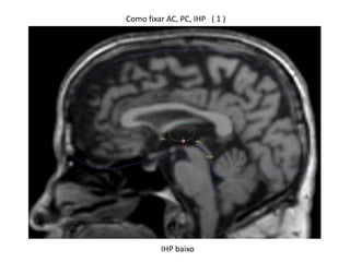 Como fixar AC, PC, IHP ( 1 )
IHP baixo
 