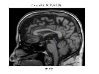 Como definir AC, PC, IHP (2)
IHP alto
 