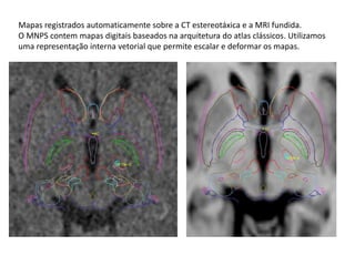Mapas registrados automaticamente sobre a CT estereotáxica e a MRI fundida.
O MNPS contem mapas digitais baseados na arquitetura do atlas clássicos. Utilizamos
uma representação interna vetorial que permite escalar e deformar os mapas.
 