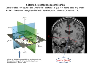 z
X
Y
MCP = (0,0,0)Tomado de: “Neurofunctional Systems: 3D Reconstructions with
Correlated Neuroimaging”. By Hans-Joachim Kretschmann,
Wolfgang Weinrich, Wolfram Fiekert
Sistema de coordenadas comissurais.
Coordenadas comissurais são um sistema cartesiano que tem como base os pontos
AC e PC. No MNPS a origem do sistema esta no ponto médio inter-comissural.
 
