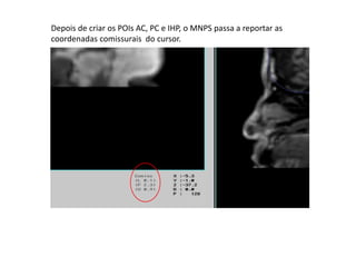 Depois de criar os POIs AC, PC e IHP, o MNPS passa a reportar as
coordenadas comissurais do cursor.
 