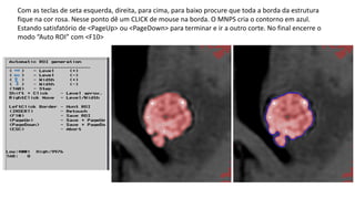 Com as teclas de seta esquerda, direita, para cima, para baixo procure que toda a borda da estrutura
fique na cor rosa. Nesse ponto dê um CLICK de mouse na borda. O MNPS cria o contorno em azul.
Estando satisfatório de <PageUp> ou <PageDown> para terminar e ir a outro corte. No final encerre o
modo “Auto ROI” com <F10> ou botão com caneta levantada.
 