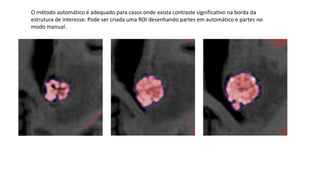 O método automático é adequado para casos onde exista contraste significativo na borda da
estrutura de interesse. Pode ser criada uma ROI desenhando partes em automático e partes no
modo manual.
 