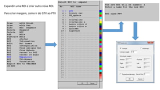 Desenho de ROI antes de ter a imagem estereotáxica.
Muitas vezes se tem acesso a sequências MRI do paciente, que serão utilizadas na fusão de
imagens, dias antes da cirurgia. O CAT3D pode ser utilizado para desenhar ROIs na MRI.
No dia da cirurgia se registram e fundem as MRI e CT estereotáxica. Após ficar satisfeito
com o resultado da fusão pode importar as ROIs feitas no CAT3D.
Abra o Menu da Fusão, com <ALT-F5> ou pelo ajuda. Selecione “Import ROIs from external
Set”.
NOTA: As ROIs feitas no CAT3D sobre-escrevem as que existam no MNPS. Por isso não
desenhe ROIs no MNPS até depois de importar as ROIs feitas no CAT3D !
 