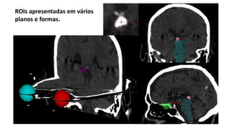 Expansão de uma ROI, resultado.
Do GTV para o PTV
 