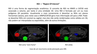 ROI = “Region Of Interest”
ROI é uma forma de segmentação anatômica. O conceito de ROI no MNPS e CAT3D está
associado a volume, por tanto é uma entidade 3D. Uma ROI é formada por um ou mais
polígonos 2D paralelos. Usualmente o mais conveniente é desenhar as ROIs em planos
horizontais (axiais), pois neste caso o MNPS/CAT3D gera mais informação útil para a ROI. Pode-
se desenhar ROIs em coronal ou sagital, mas elas não serão renderizadas como sólidos em 3D,
não podem ser interpoladas ou expandidas, além de outras limitações.
ROI como “wire frame” ROI sólida
Caso de um neurinoma sendo planejado para SRS
 