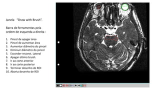 Janela “Draw with Brush”.
Barra de ferramentas pela
ordem de esquerda a direita :
1. Pincel de apagar área
2. Pincel de aumentar área
3. Aumentar diâmetro do pincel
4. Diminuir diâmetro do pincel
5. Esconder reconst. Lateral
6. Apagar último brush.
7. Ir ao corte anterior
8. Ir ao corte posterior
9. Terminar desenho de ROI
10. Aborta desenho de ROI
 