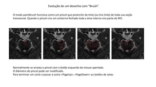 Evolução de um desenho com “Brush”.
O modo paintbrush funciona como um pincel que preenche de tinta (ou tira tinta) de toda sua seção
transversal. Quando o pincel cria um contorno fechado toda a área interna vira parte da ROI.
Normalmente se arrasta o pincel com o botão esquerdo do mouse apertado.
O diâmetro do pincel pode ser modificado.
Para terminar um corte e passar a outro <PageUp>, <PageDown> ou botões de setas.
 
