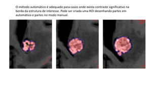 O método automático é adequado para casos onde exista contraste significativo na
borda da estrutura de interesse. Pode ser criada uma ROI desenhando partes em
automático e partes no modo manual.
 