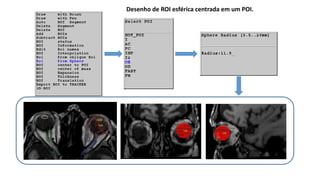 Desenho de ROI esférica centrada em um POI.
 
