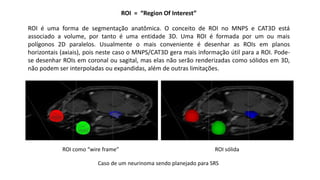 ROI = “Region Of Interest”
ROI é uma forma de segmentação anatômica. O conceito de ROI no MNPS e CAT3D está
associado a volume, por tanto é uma entidade 3D. Uma ROI é formada por um ou mais
polígonos 2D paralelos. Usualmente o mais conveniente é desenhar as ROIs em planos
horizontais (axiais), pois neste caso o MNPS/CAT3D gera mais informação útil para a ROI. Pode-
se desenhar ROIs em coronal ou sagital, mas elas não serão renderizadas como sólidos em 3D,
não podem ser interpoladas ou expandidas, além de outras limitações.
ROI como “wire frame” ROI sólida
Caso de um neurinoma sendo planejado para SRS
 