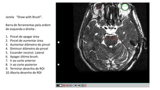 Janela “Draw with Brush”.
Barra de ferramentas pela ordem
de esquerda a direita :
1. Pincel de apagar área
2. Pincel de aumentar área
3. Aumentar diâmetro do pincel
4. Diminuir diâmetro do pincel
5. Esconder reconst. Lateral
6. Apagar último brush.
7. Ir ao corte anterior
8. Ir ao corte posterior
9. Terminar desenho de ROI
10.Aborta desenho de ROI
 