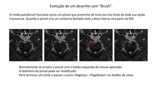 Evolução de um desenho com “Brush”.
O modo paintbrush funciona como um pincel que preenche de tinta (ou tira tinta) de toda sua seção
transversal. Quando o pincel cria um contorno fechado toda a área interna vira parte da ROI.
Normalmente se arrasta o pincel com o botão esquerdo do mouse apertado.
O diâmetro do pincel pode ser modificado.
Para terminar um corte e passar a outro <PageUp>, <PageDown> ou botões de setas.
 