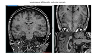 Sequências de MRI também podem ser coronais.
 