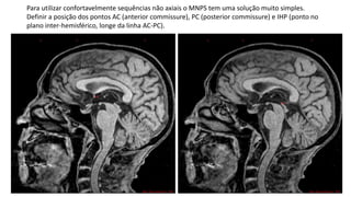 Para utilizar confortavelmente sequências não axiais o MNPS tem uma solução muito simples.
Definir a posição dos pontos AC (anterior commissure), PC (posterior commissure) e IHP (ponto no
plano inter-hemisférico, longe da linha AC-PC).
 