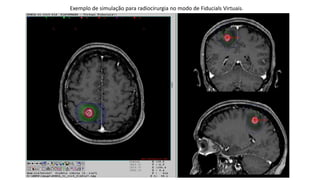 Exemplo de simulação para radiocirurgia no modo de Fiducials Virtuais.
 