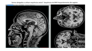 Somos obrigados a utilizar sequências axiais? Sequências de MRI frequentemente são sagitais:
 