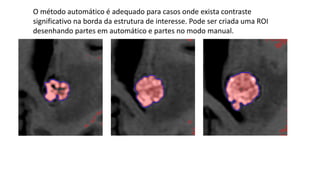 O método automático é adequado para casos onde exista contraste
significativo na borda da estrutura de interesse. Pode ser criada uma ROI
desenhando partes em automático e partes no modo manual.
 