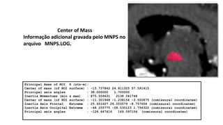 Principal Axes of ROI 8 (stn-e):
Center of mass (of ROI surface) : -15.737842 24.811325 57.591415
Principal axis angles : 38.000000 1.700000
Inertia Momentums (min & max) : 875.559631 2138.041748
Center of mass (of ROI surface) : -11.301948 -1.238154 -3.500875 (comissural coordinates)
Inertia Axis Frontal Extreme : 25.651627 26.053579 -8.757654 (comissural coordinates)
Inertia Axis Occipital Extreme : -48.255775 -28.530123 1.756322 (comissural coordinates)
Principal axis angles : -126.447416 169.097154 (comissural coordinates)
Center of Mass
Informação adicional gravada pelo MNPS no
arquivo MNPS.LOG.
 