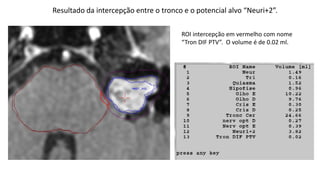 Resultado da intercepção entre o tronco e o potencial alvo “Neuri+2”.
ROI intercepção em vermelho com nome
“Tron DIF PTV”. O volume é de 0.02 ml.
 