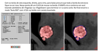 Com as teclas de seta esquerda, direita, para cima, para baixo procure que toda a borda da estrutura
fique na cor rosa. Nesse ponto dê um CLICK de mouse na borda. O MNPS cria o contorno em azul.
Estando satisfatório dê <PageUp> ou <PageDown> para terminar e ir a outro corte. No final encerre o
modo “Auto ROI” com <F10> ou botão com caneta levantada.
 