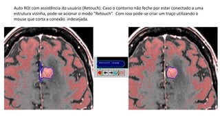 Auto ROI com assistência do usuário (Retouch). Caso o contorno não feche por estar conectado a uma
estrutura vizinha, pode-se acionar o modo “Retouch”. Com isso pode-se criar um traço utilizando o
mouse que corta a conexão indesejada.
 