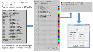 Expandir ou Encolher uma ROI e criar
outra nova ROI.
Para criar margem, como ir do GTV ao PTV
Para encolher uma ROI utilizamos margem
negativa. Este caso é somente isotrópico.
 