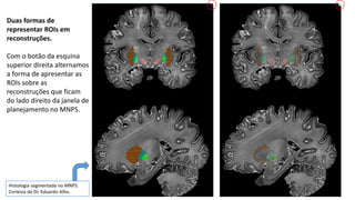 Duas formas de
representar ROIs em
reconstruções.
Com o botão da esquina
superior direita alternamos
a forma de apresentar as
ROIs sobre as
reconstruções que ficam
do lado direito da janela de
planejamento no MNPS.
Histologia segmentada no MNPS.
Cortesia do Dr. Eduardo Alho.
 