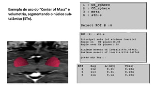 Exemplo de uso do “Center of Mass” e
volumetria, segmentando o núcleo sub-
talâmico (STn).
 