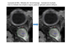 Suavizado de ROIs. Métodos 2D. Kernel Average. Exemplo de resultado.
Este é o método mais simples e seguro, pode ser aplicado a planos oblíquos.
 