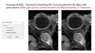 Suavizado de ROIs. “Volumetric Smoothing 3D”. É um procedimento 3D, afeta a ROI
como volume. NOTA: Este recurso somente funciona em ROIs horizontais, Z = Constante.
 