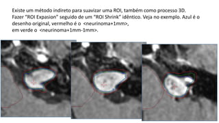 Existe um método indireto para suavizar uma ROI, também como processo 3D.
Fazer “ROI Expasion” seguido de um “ROI Shrink” idêntico. Veja no exemplo. Azul é o
desenho original, vermelho é o <neurinoma+1mm>,
em verde o <neurinoma+1mm-1mm>.
 