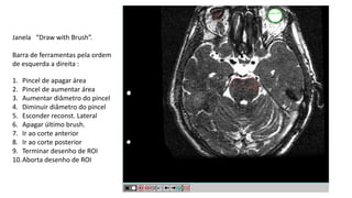 Janela “Draw with Brush”.
Barra de ferramentas pela ordem
de esquerda a direita :
1. Pincel de apagar área
2. Pincel de aumentar área
3. Aumentar diâmetro do pincel
4. Diminuir diâmetro do pincel
5. Esconder reconst. Lateral
6. Apagar último brush.
7. Ir ao corte anterior
8. Ir ao corte posterior
9. Terminar desenho de ROI
10.Aborta desenho de ROI
 