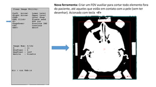 Nova ferramenta: Criar um FOV auxiliar para cortar todo elemento fora
do paciente, até aqueles que estão em contato com a pele (sem ter
desenhar). Acionado com tecla <F>
 