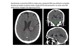 Geralmente o isocentro (POI) é criado com a ajuda de ROIs que definem as bordas
do alvo em todos os planos onde a lesão (GTV) está presente e as vezes esta ROI
pode incluir margens de segurança (PTV).
 